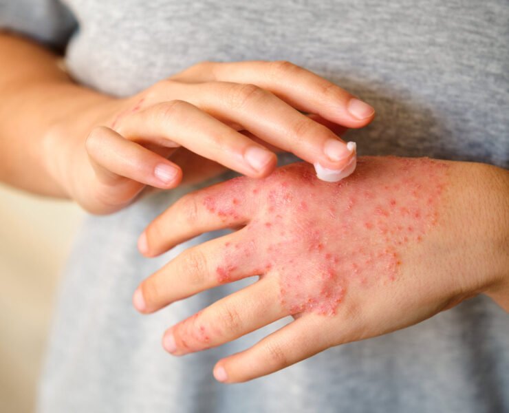 Unrecognizable woman applying ointment or moisturizing cream in the treatment of eczema on hand, atopic dermatitis.